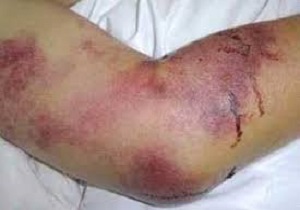 مبارزه با عوامل بیماری‌زا تب کریمه کنگو استان‌ تشدید شد