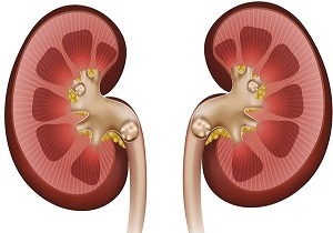 چگونه بدون دارو به جنگ سنگ کلیه برویم؟