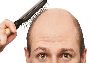تشخیص طاسی از طریق ژنوم نوزاد