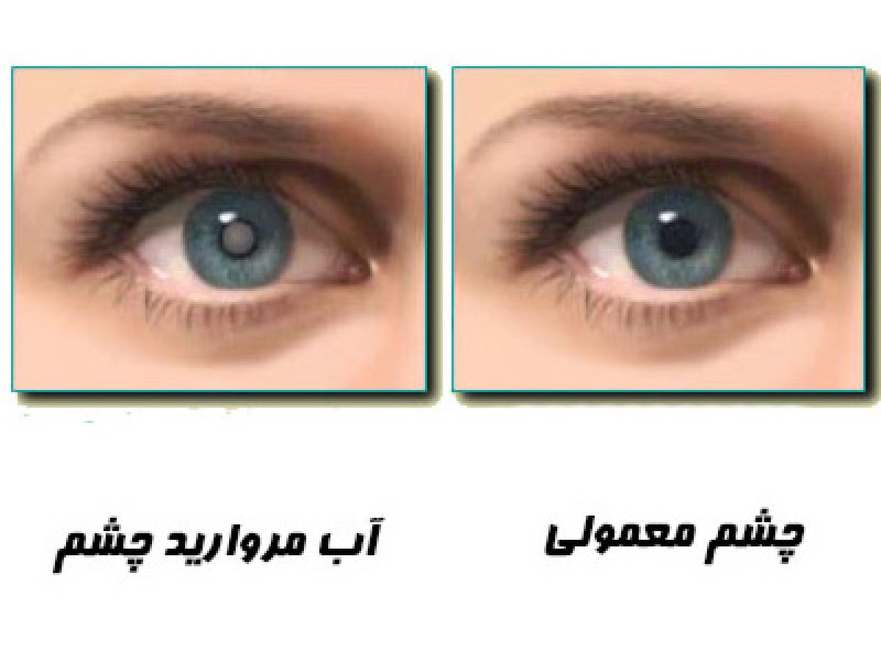 نشانه های ابتلا به آب مروارید کدام است؟