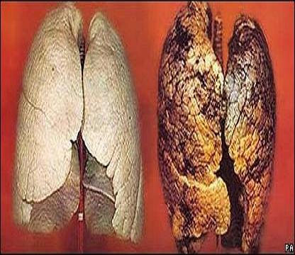 عمل باز ریه یک فرد سیگاری+ فیلم