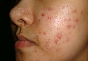 جای جوش‌ها را به کمک این دارو محو کنید