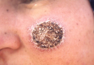 اجرای طرح مقابله با بیماری سالک در جهرم