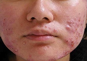 استرس عامل مهم بروز و تشدید ضایعات جوش غرور جوانی