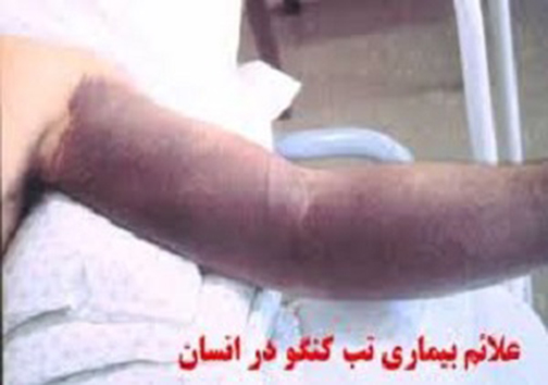 آنچه باید درمورد تب کریمه- کنگو بدانیم