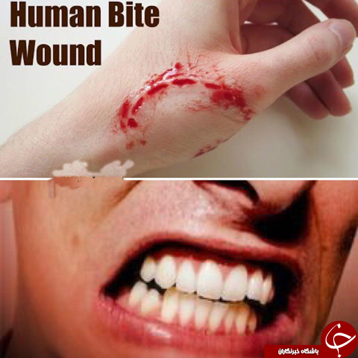 گاز گرفتن انسان&zwnj;ها از حیوانات خطرناک&zwnj;تر است +عکس