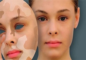 لک و پیس چگونه پوست را درگیر می‌کند؟