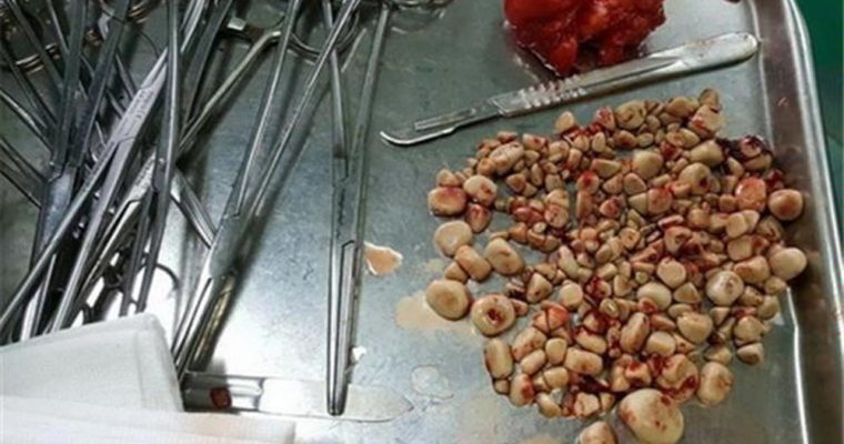 همه چیز در مورد سنگ مثانه