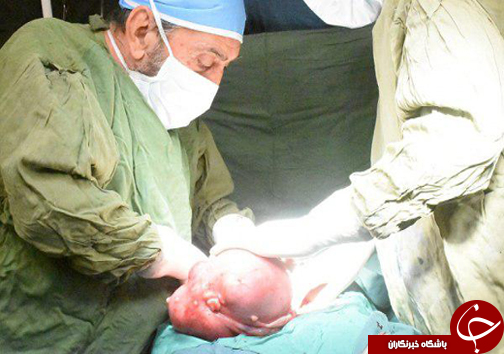 خارج کردن تومور ۶ کیلویی از بدن خانم  ۴۴ ساله + تصاویر