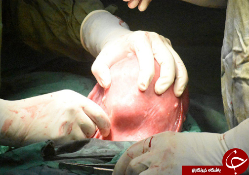 خارج کردن تومور ۶ کیلویی از بدن خانم  ۴۴ ساله + تصاویر