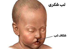 اعزام 400 بیمار با ناهنجاری های حاد صورت به تهران