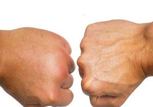 احتباس آب در بدن؛ دلایل و راهکارها