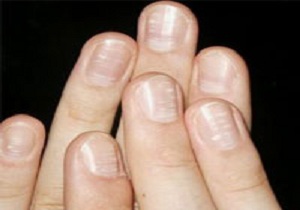 ناخن های دست ها، در مورد سلامت شما چه می گویند؟