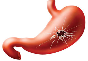 چگونگی ایجاد زخم معده + فیلم