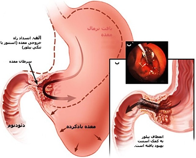 چرا سرطان معده می&zwnj;گیریم؟