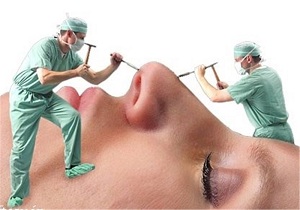 عمل زوایه‌‌دار کردن چانه !