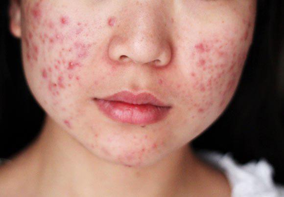 مشهورترین بیماری&zwnj;های پوستی+ تصاویر