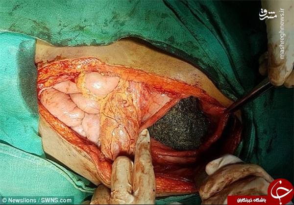 خارج کردن توده مو ۱۳ کیلویی از معده دختر هندی+عکس