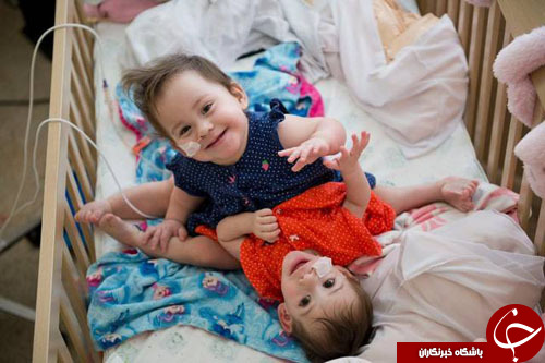 جداسازی دوقلوهای به هم چسبیده با امعاء و احشای مشترک+ تصاویر