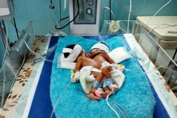 علت مرگ دوقلوهای نیکشهری اعلام شد