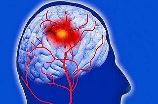 فاکتورهای پرخطری که بیماران سکته مغزی را تهدید می کند