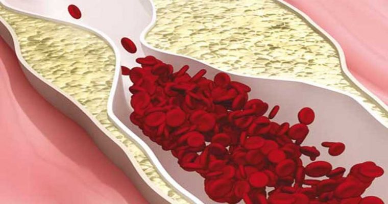 اختلالات چربی خون را چگونه کنترل کنیم؟