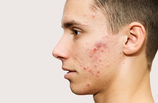 راهی برای به از بین بردن جوش های صورت