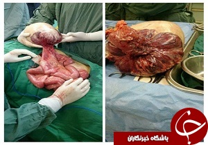 خوش نشینی توده‌ بزرگ در شکم یک پیرمرد