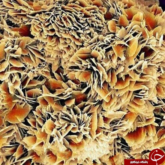 نمای متفاوت از سنگ کلیه +عکس نمای متفاوت از سنگ کلیه +عکس