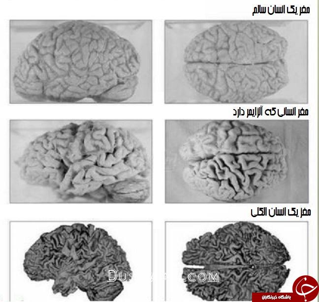 مقایسه مغز انسان عادی با یک انسان الکلی +عکس مقایسه مغز انسان عادی با یک انسان الکلی +عکس