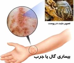 خارش شدید پوست، یکی از نشانه&zwnj;های مهم بیماری &laquo;گال&raquo;