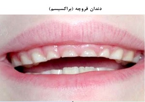 دلایل بروز عارضه &laquo;دندان قروچه&raquo; در کودکان