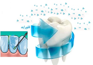 اجرای طرح وارنیش فلوراید در استان کرمانشاه
