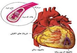 انجام نخستین آنژیوگرافی و آنژیوپلاستی قلب از طریق انگشت دست در قم