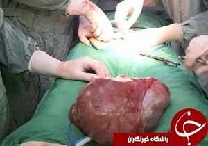 خارج کردن توده از بدن بیمار سالمند