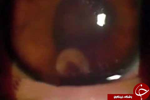 کرمی که در چشم پسری نوجوان جاخوش کرده بود+ تصاویر