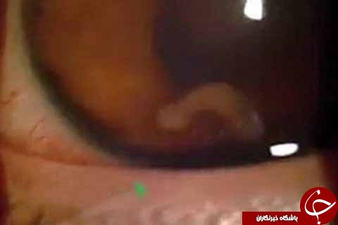 کرمی که در چشم پسری نوجوان جاخوش کرده بود+ تصاویر