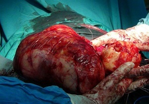 خارج کردن توده ۴ کیلویی از شکم بیمار قمی