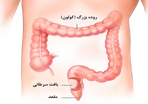 همه چیز درباره سرطان روده بزرگ