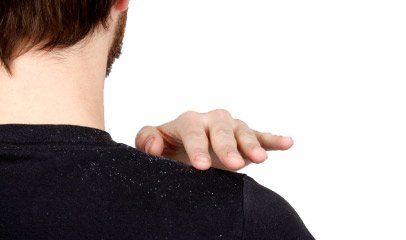 دلایلی که دانه‌های برفی بین مو‌ها جا خوش می‌کند+ اینفوگرافی