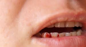 چرا لثه خونریزی می&zwnj;کند؟