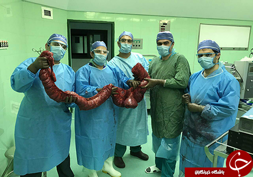 خارج کردن روده بزرگ ۸ کیلویی از شکم آقای ۷۰ ساله در بابل + تصاویر