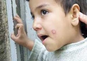 افزایش اعتبار مبارزه با بیماری سالک در بافق