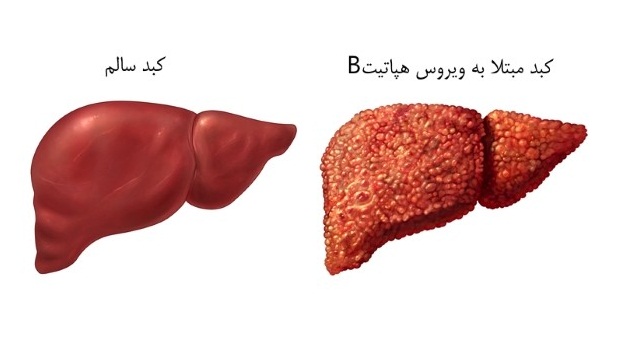 ابراز نگرانی درباره سرنوشت ۵۲ میلیون کودک آلوده به هپاتیت
