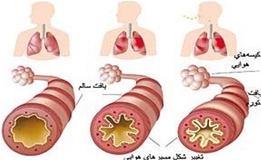 آسم سوغات نفس گیر ارثی و آلاینده ها آسم سوغات نفس گیر ارثی و آلاینده ها
