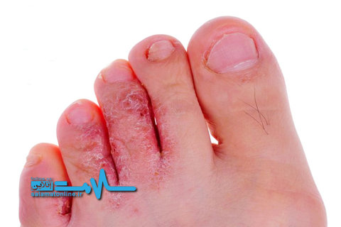 چرا هیچ&zwnj;گاه نباید بدون جوراب کفش پوشید؟