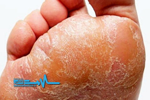 چرا هیچ&zwnj;گاه نباید بدون جوراب کفش پوشید؟