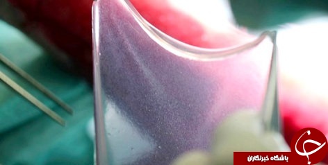 کودک دچار بیماری نادر با ژن&zwnj;درمانی صاحب پوستی تازه شد+تصاویر