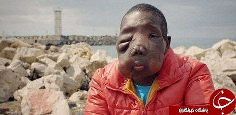 تومور عجیب در صورت پسر 11 ساله