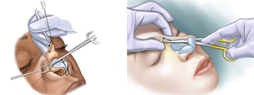 1-اعتیاد به دارو&zwnj;های مسکن به دلیل انجام این جراحی زیبایی پرطرفدار2-اعتیاد عجیب و وباورنکردنی به دارو&zwnj;های مسکن به دلیل جراحی زیبایی پرطرفدار3- اعتیاد به داروهایی خطرناک به دلیل تلاش برای زیبا شدن